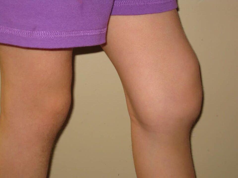 Pathologie du genou dans l'arthrose avancée