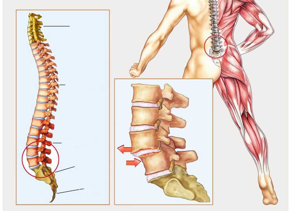 colonne vertébrale saine et malade