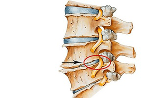 Disque intervertébral pincé dans la colonne vertébrale comme cause d'ostéochondrose cervicale