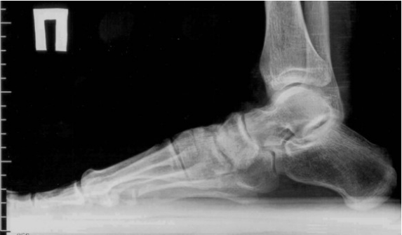 Arthrose des orteils et des pieds