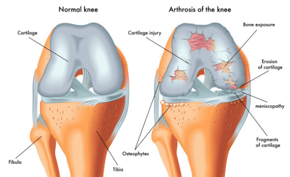Joint normal et influencé par l'arthrose